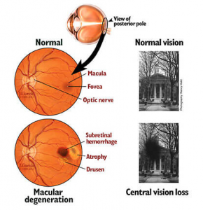 Age-Related Macular Degeneration