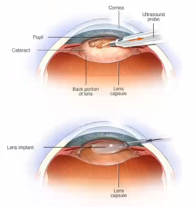 Diagram of Cataract Surgery