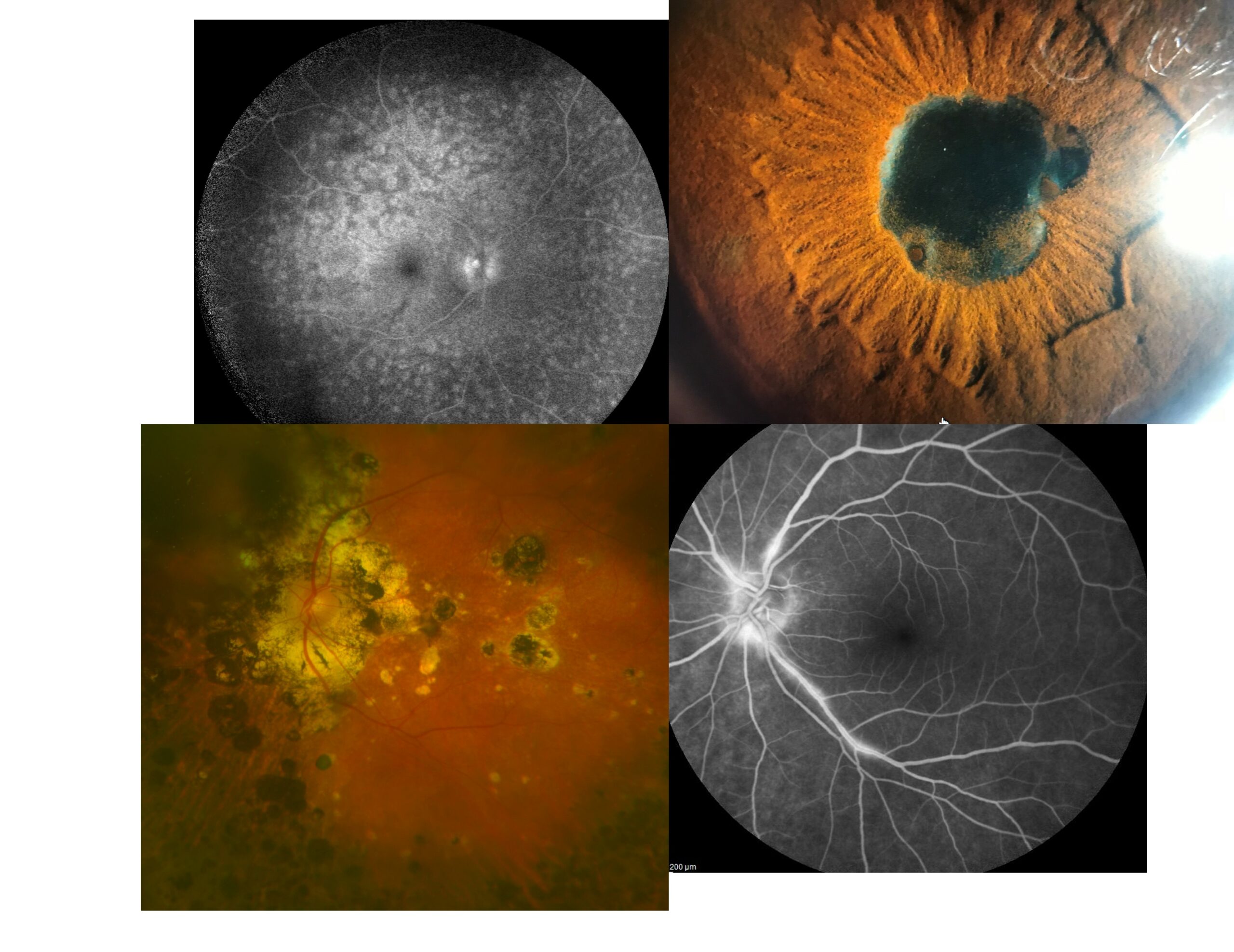 Uveitis Clinical Trial Eye & Ear Foundation of Pittsburgh