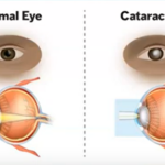 normal eye vs cataract eye graphic