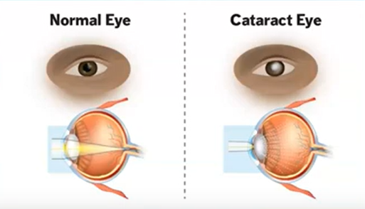 normal eye vs cataract eye graphic