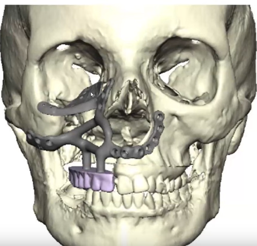 CT scan of a patient's face with gaps filled in