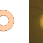 Screenshot from the webinar of an eye with and without glaucoma