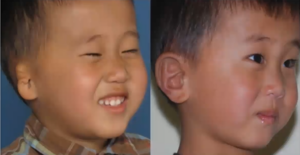 Before and after photos of a boy with microtia