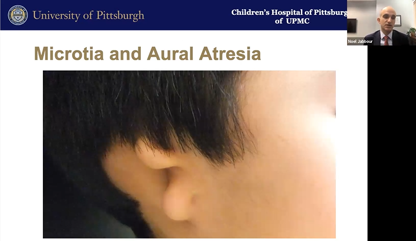 Screenshot of webinar slide that shows a boy with microtia