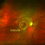 image of a macula