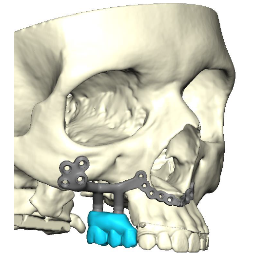 Engineering mock up photo of Madalyn Trainer's implant