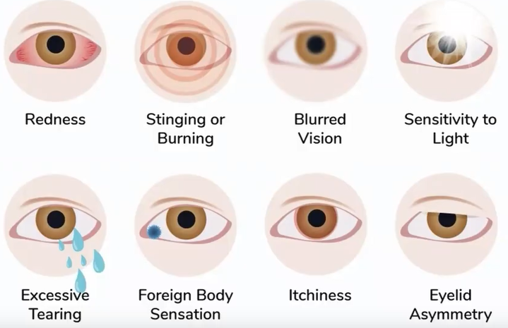 graphic of eyes displaying dry eye symptoms