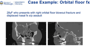 orbital floor fracture case example x-ray