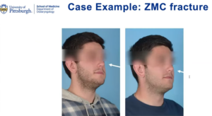 ZMC fracture photos from after surgery