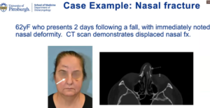 case example nasal fracture picture and x-ray