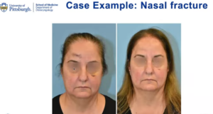 case example nasal fracture after photos