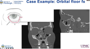 case example orbital floor fracture after
