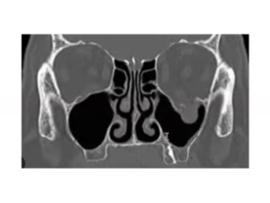 orbital floor fracture x-ray