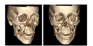 panfacial trauma x-rays