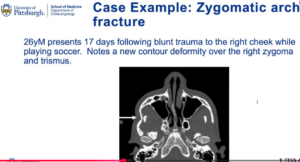 zygomatic arch fracture x-ray