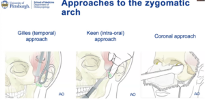 approaches to the zygomatic arch
