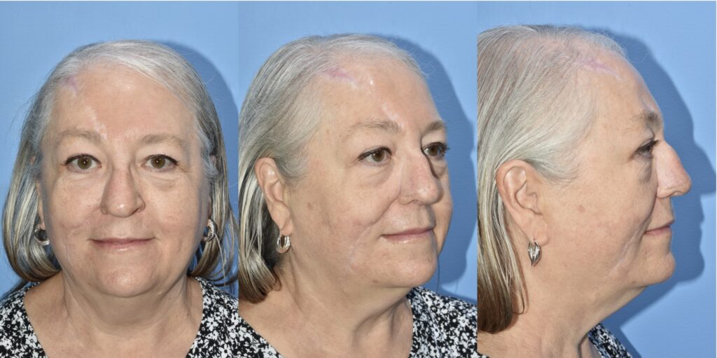 Three photos of Kathy a year post reconstruction