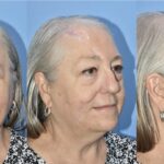 Three photos of Kathy a year post reconstruction