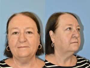 Front and side photo of Kathy pre-op