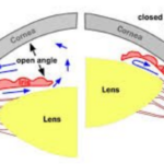 illustration of open vs closed angles